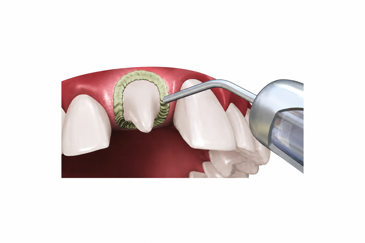 DPI Hemostatic Gel Gingival Retraction Gel - Image 3
