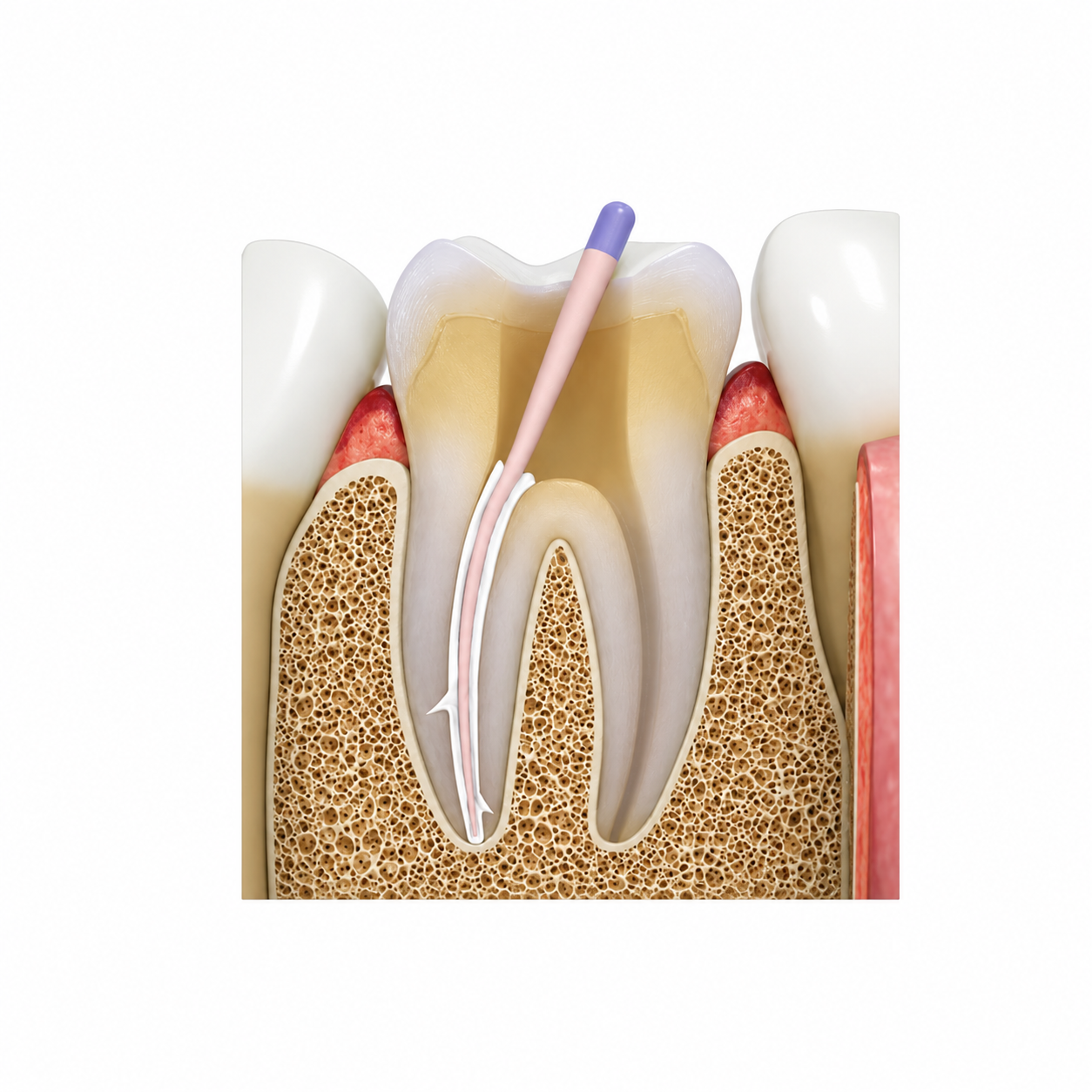 Maarc Sealmax-R Resin Based Root Canal Sealer - Image 6