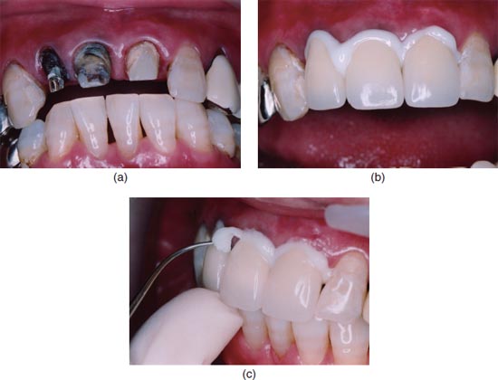 Fusion Ultra D/C Dual Cure Resin Based Luting Cement – Automix 9g - Image 2